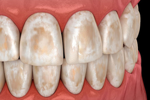 Close-up of teeth with abfractions