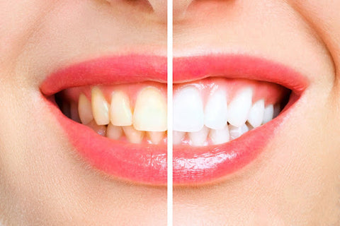 Before and after teeth whitening mouth close-up