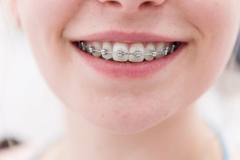 Closeup of young person smiling with braces (JS Dental)