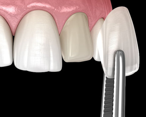 Veneers for abfracted teeth