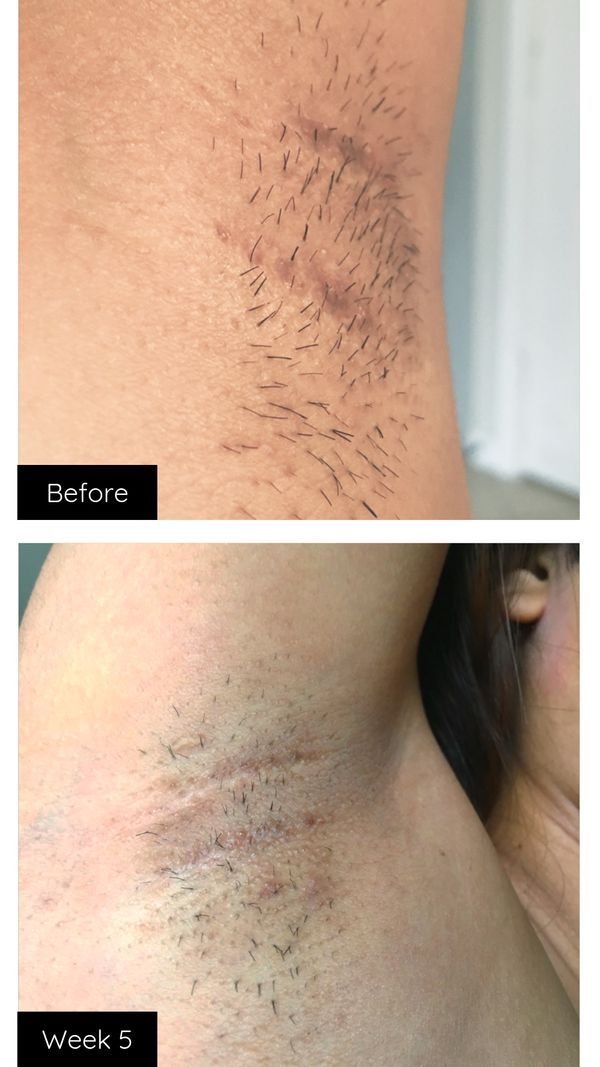 53 Best Images How Much Is Laser Hair Removal For Armpits - Laser Hair Removal London London Premier Laser Clinic