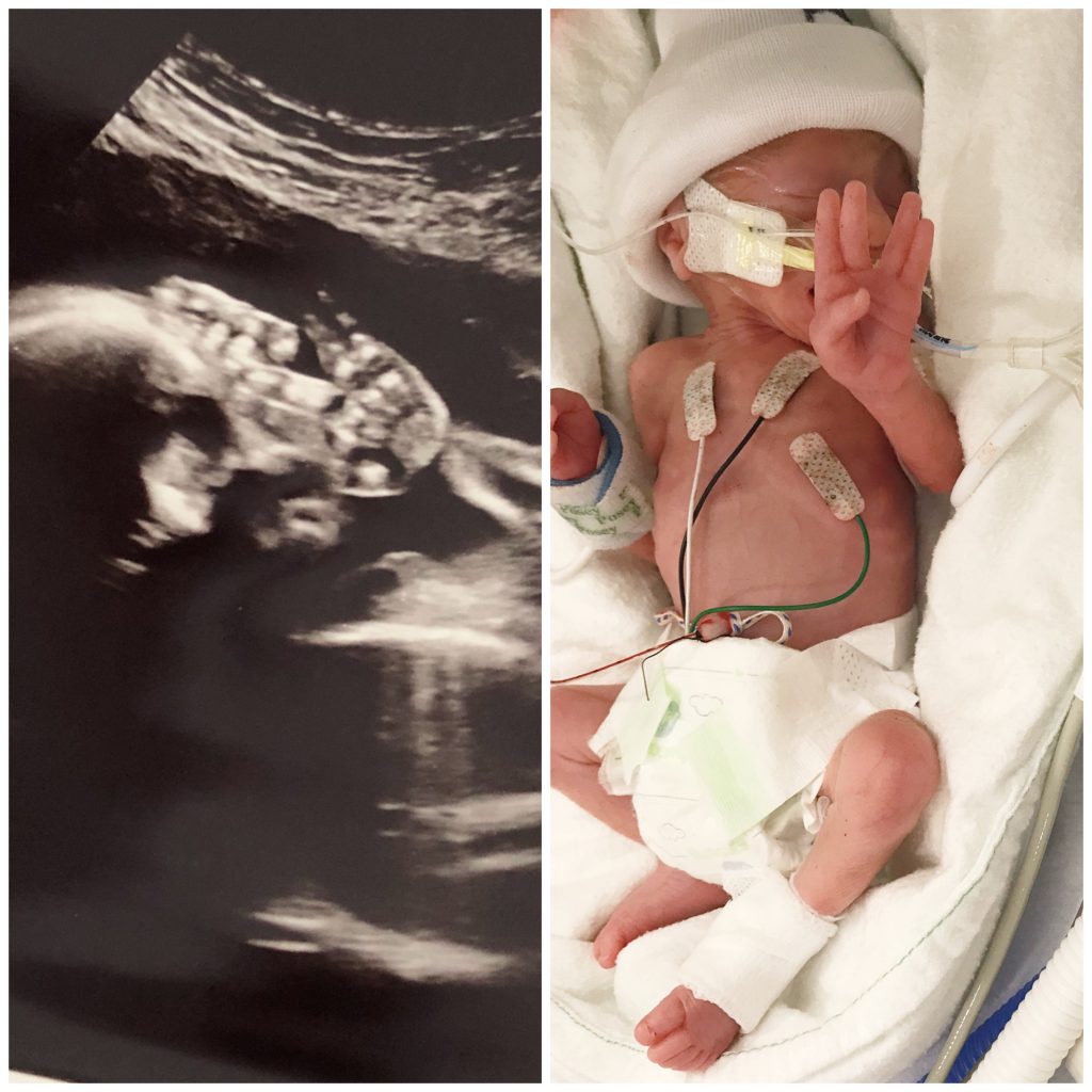 My Twin Birth Story - TTTS Survivors