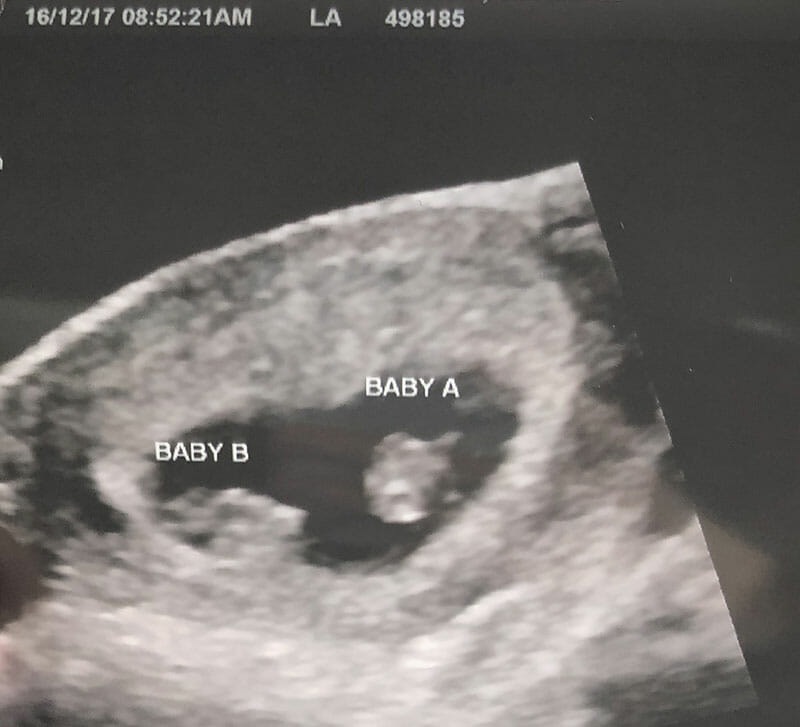 8 week ultrasound