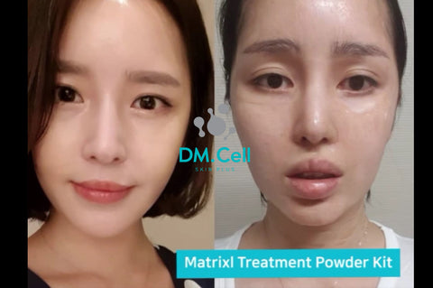anti-wrinkle matrixl lifting treatment v-line program Korean skin care dm cell