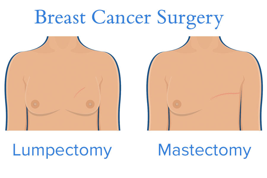 Breast Cancer Surgery Diagram