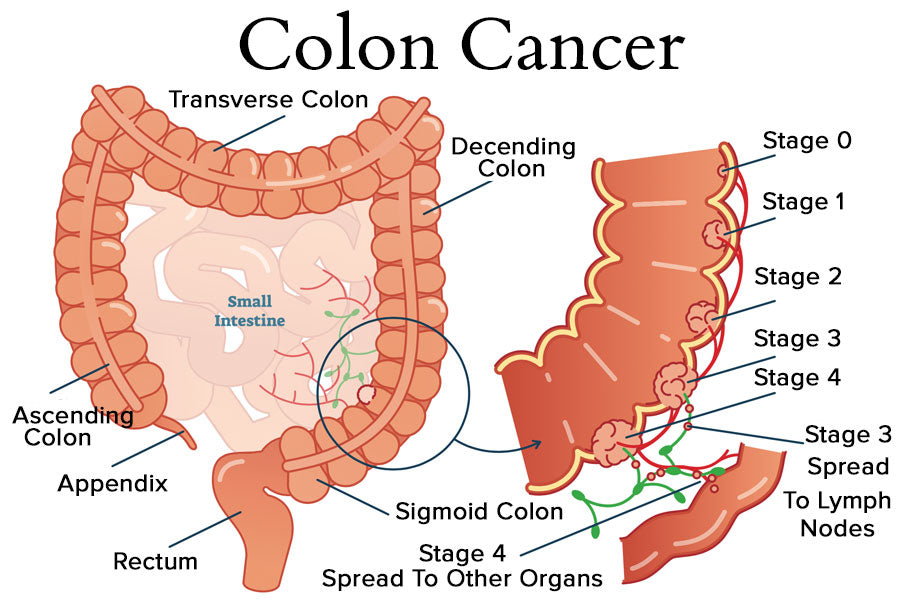 Colon Cancer Diagram