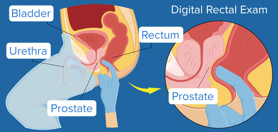 Digital Rectal Exam, DRE Diagram