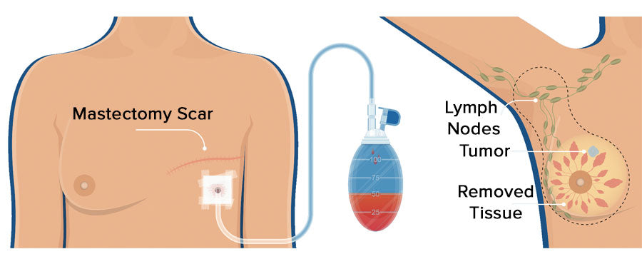 Mastectomy Diagram