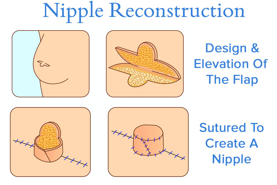 Nipple Reconstruction Diagram