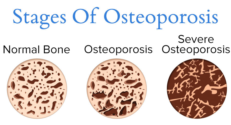 Osteoporosis Diagram: Bone Loss