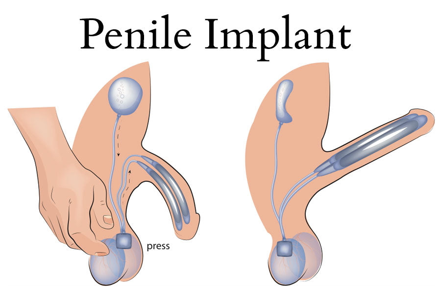 Penile Implant Diagram
