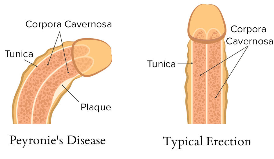 Peyronie's Disease Diagram