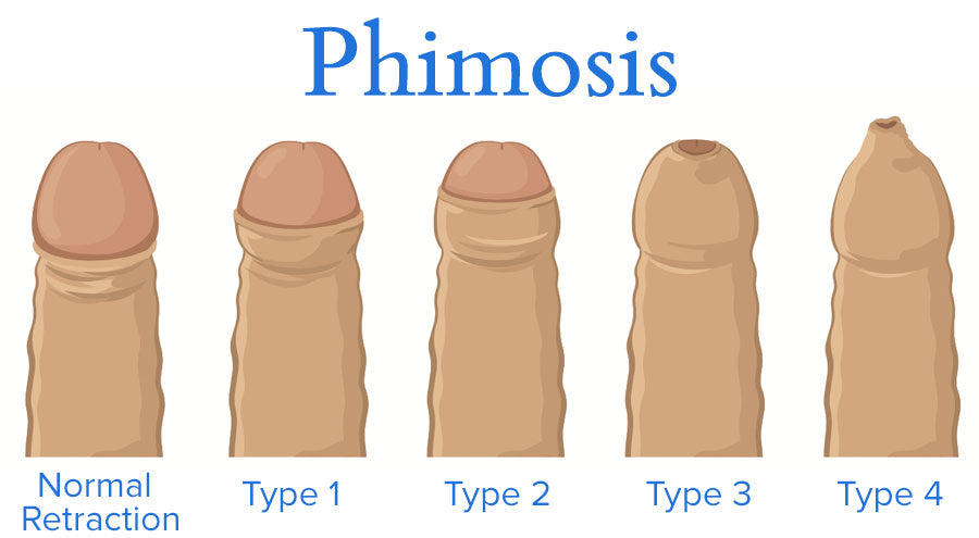 Phimosis Diagram