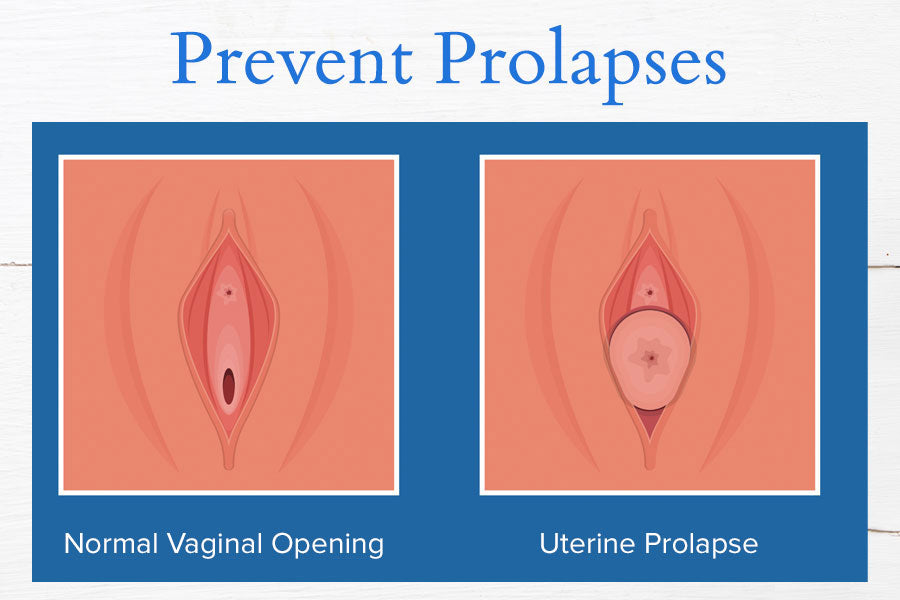 Prevent Uterine Prolapse Diagram
