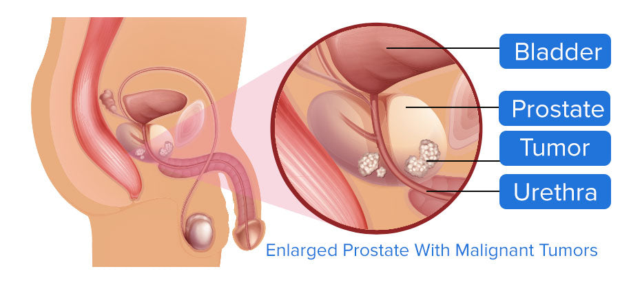Prostate Cancer Diagram