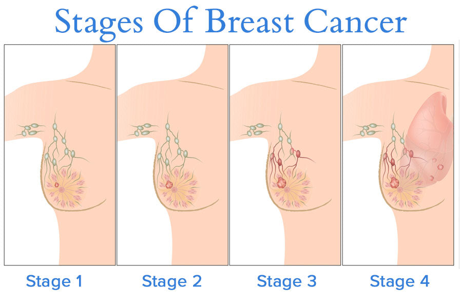 Stages Of Breast Cancer Diagram