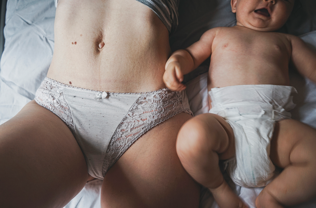 Postpartum Stretch Marks