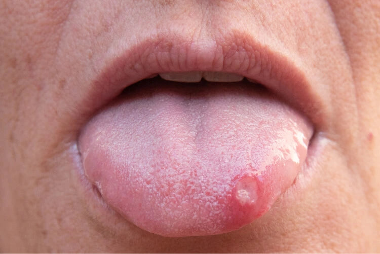 Kvinde med blist på tungen