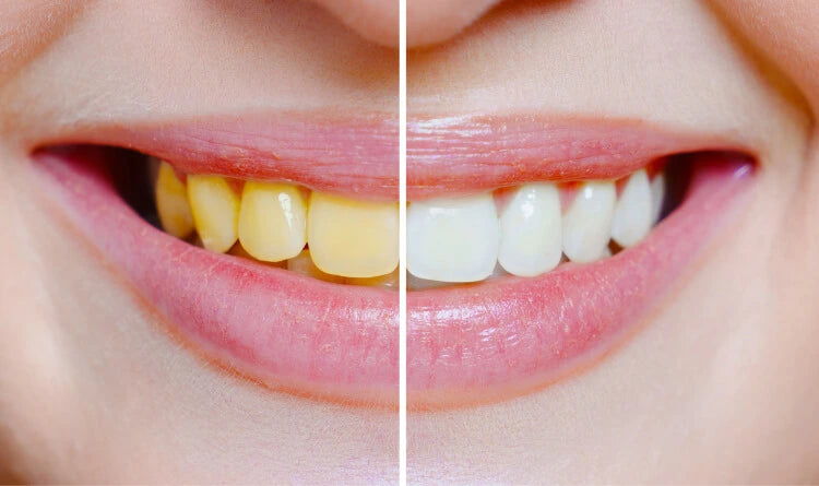 Gule tænder vs hvide tænder
