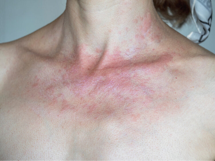 Kvinde med solallergi på øvre bryst/hals