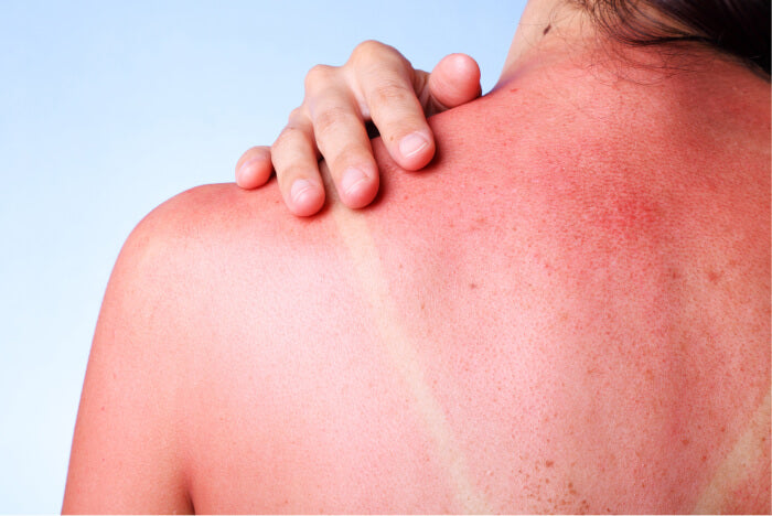 Solbrændt hud på ryggen