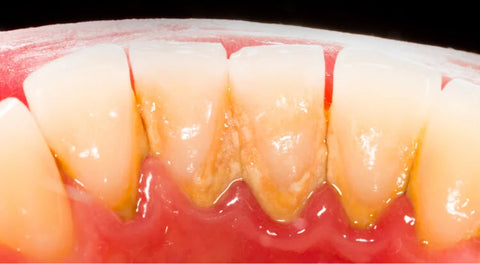 Tandsten på indersiden af tænderne