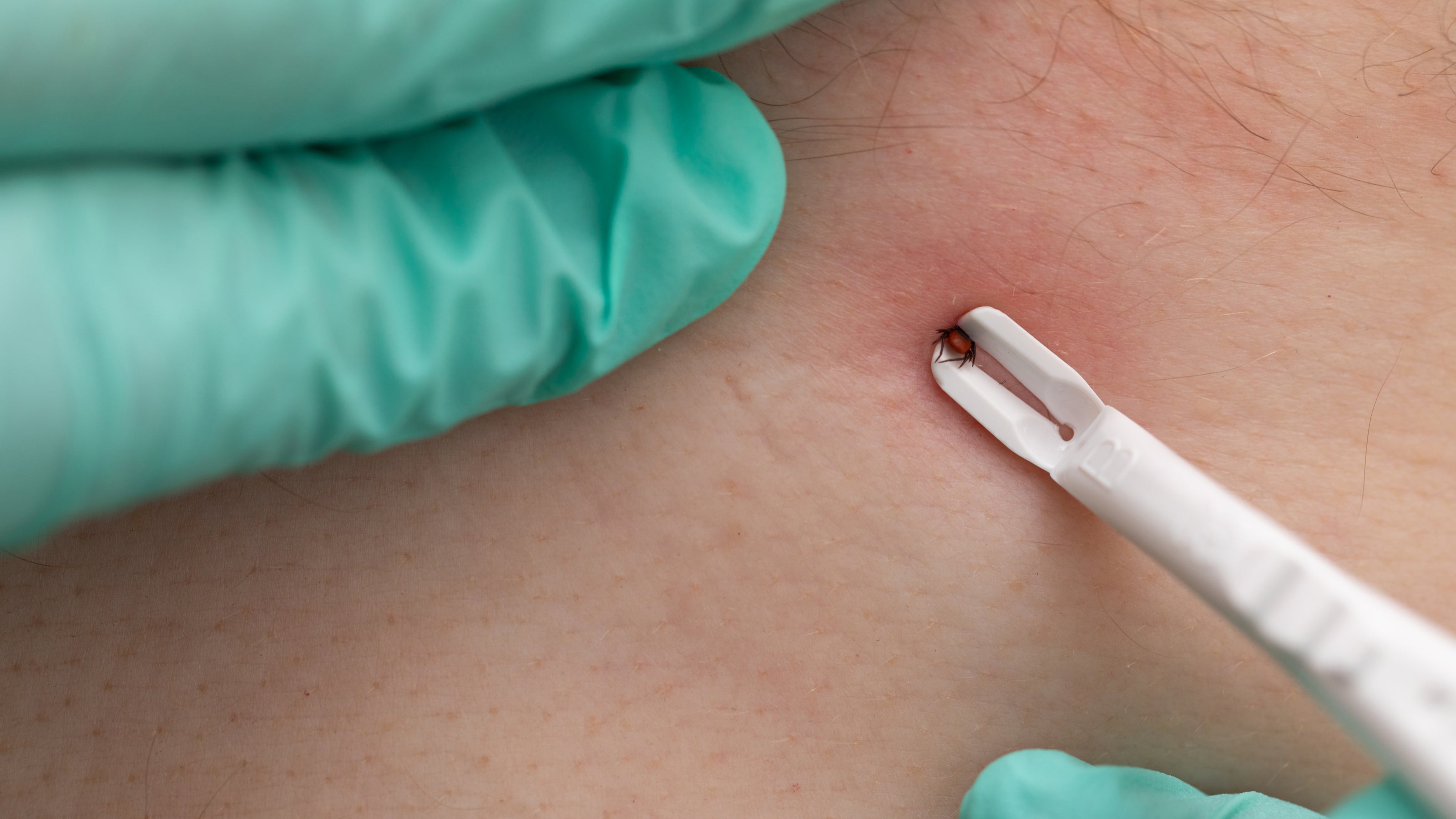 A tick is removed with a pair of white tweezers