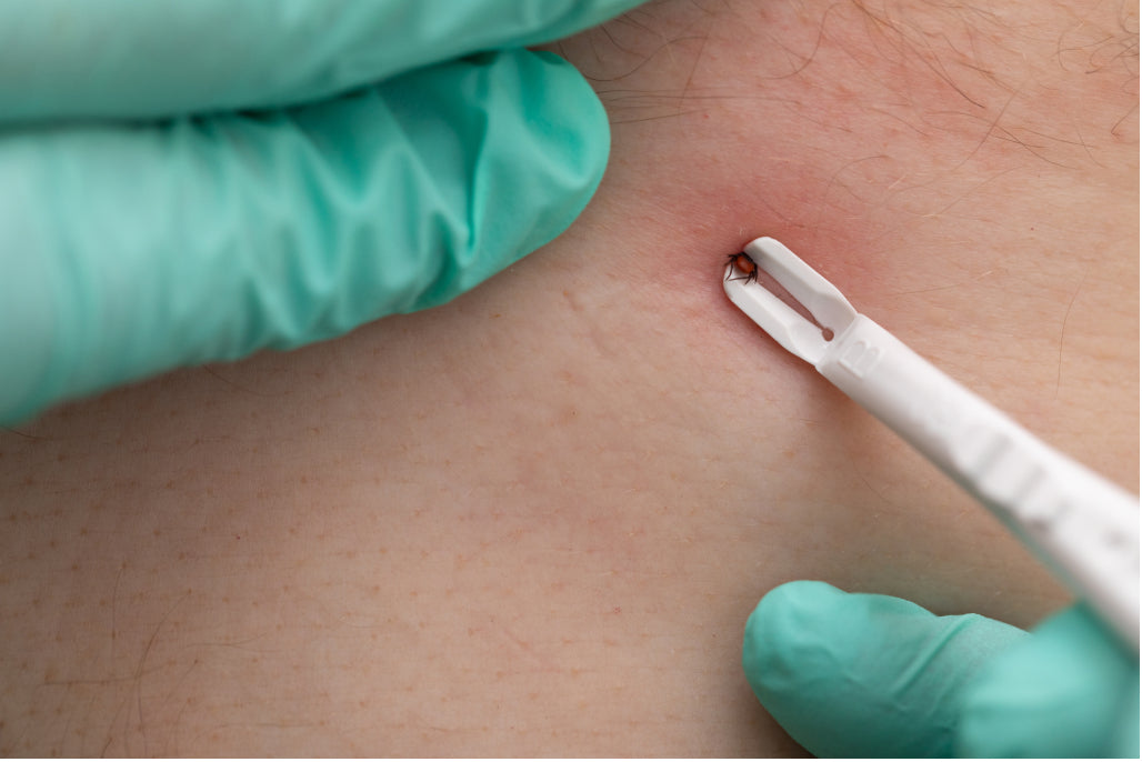 A tick removal device is used to remove a tick embedded on the neck of a patient