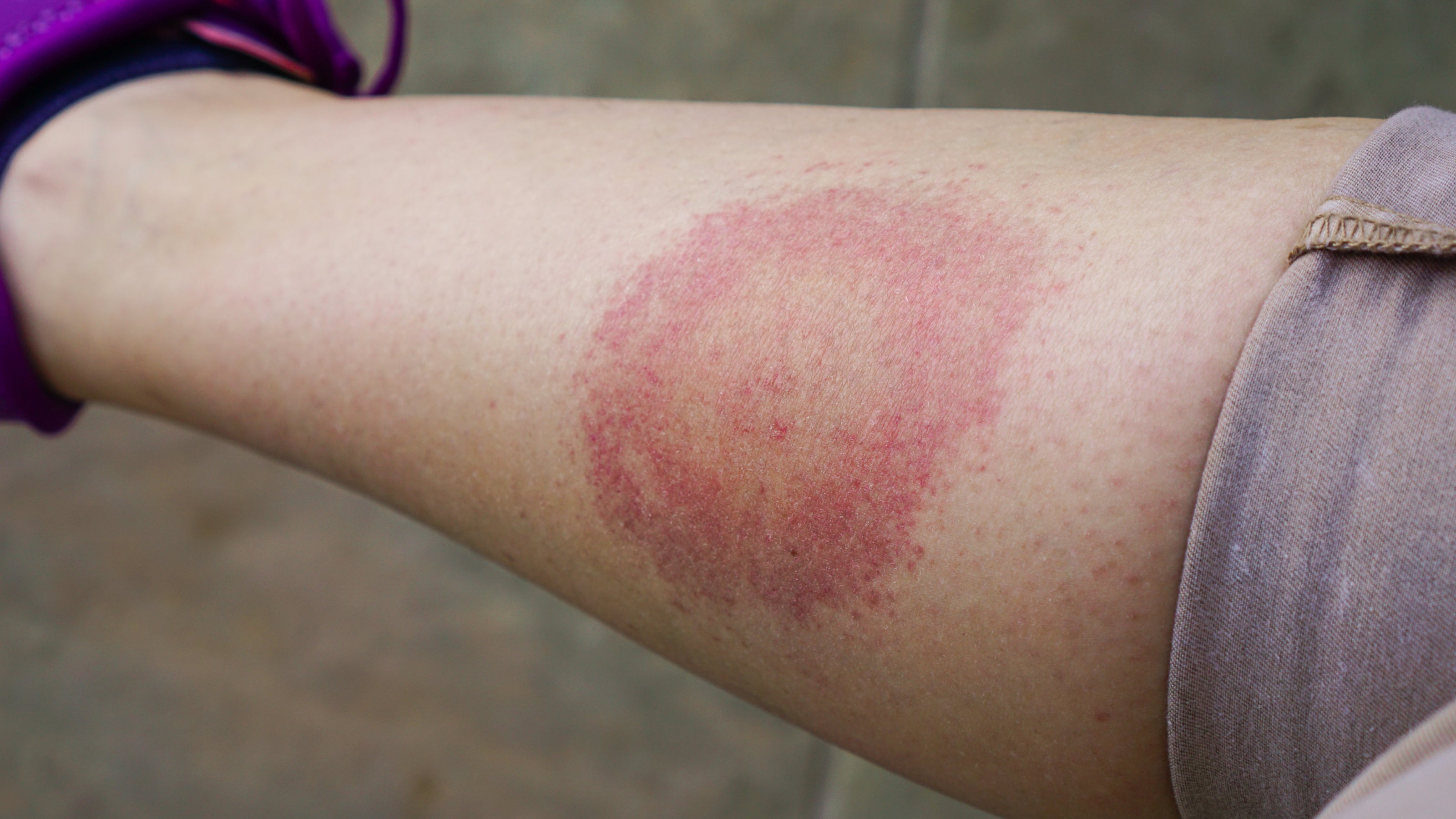A tick ring rash on a leg