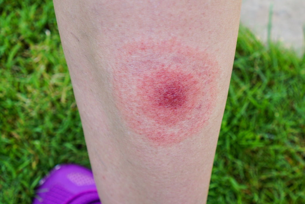 A ring like rash called the bullseye rash appearing on the leg of a person who may be at risk for Lyme Disease