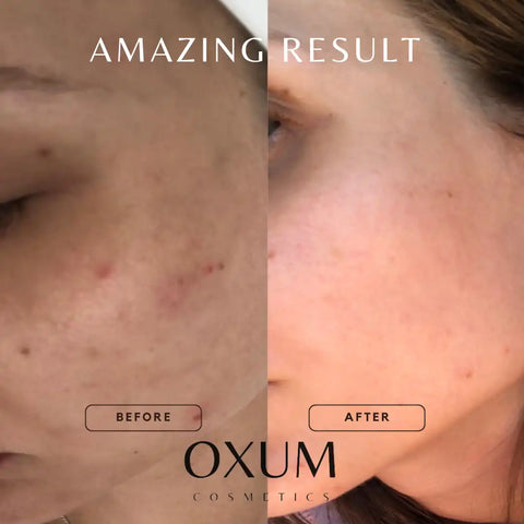 Skin Before and After using OXUM Cosmetic product
