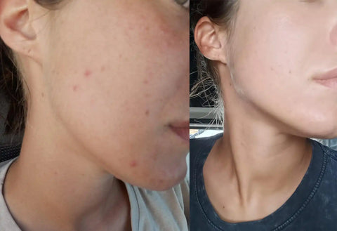 before and after comparison of skin texture