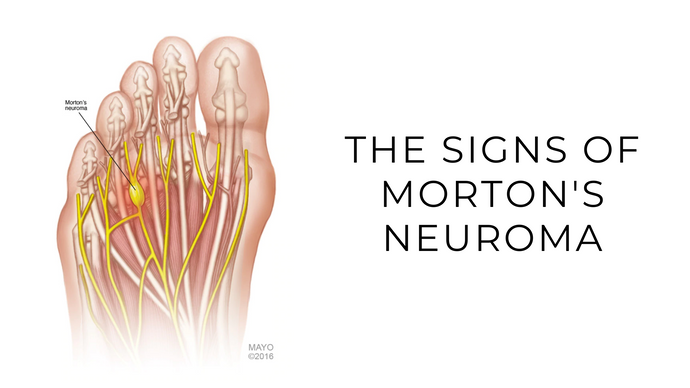 The Signs Of Morton's Neuroma – My Foot First