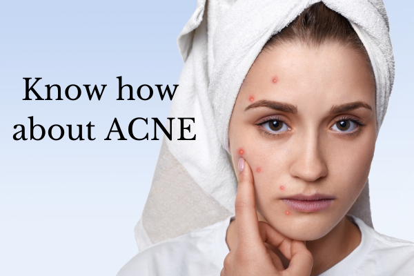 Acne What You Should Know About Acne Mystiq Living