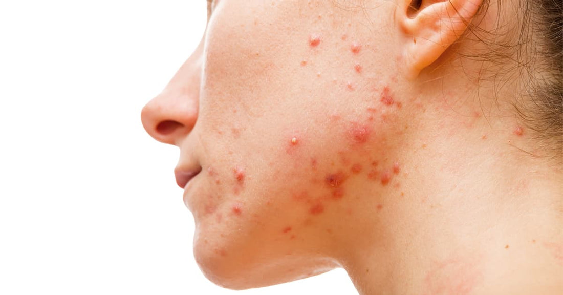 best spot treatment for cystic acne