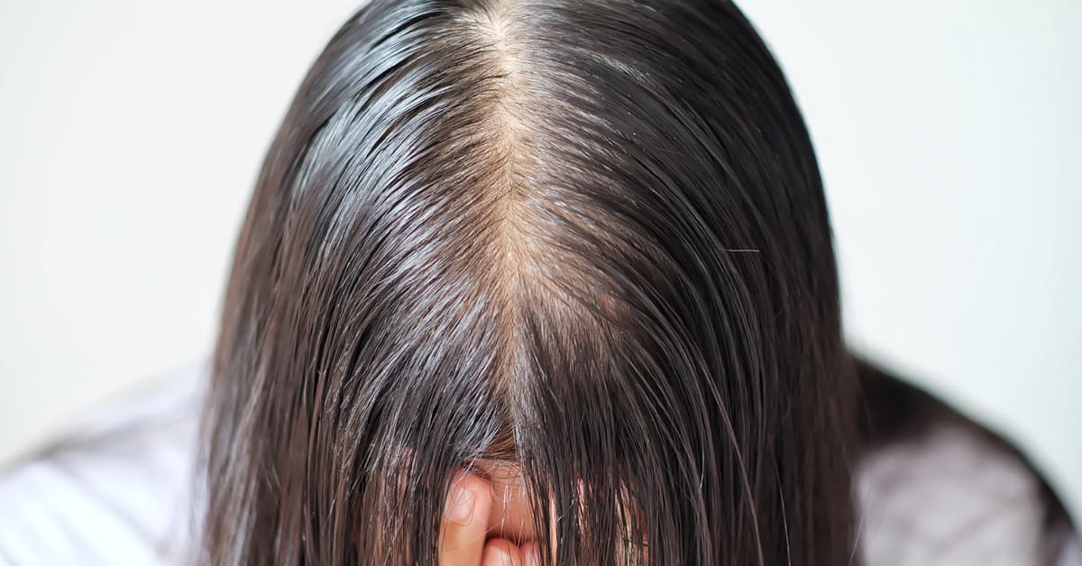 Halabo Hair  Dandruff is the most common scalp problem that affects  majority of the people Although we often heard about dandruff we are  unable to tell the differences between each type