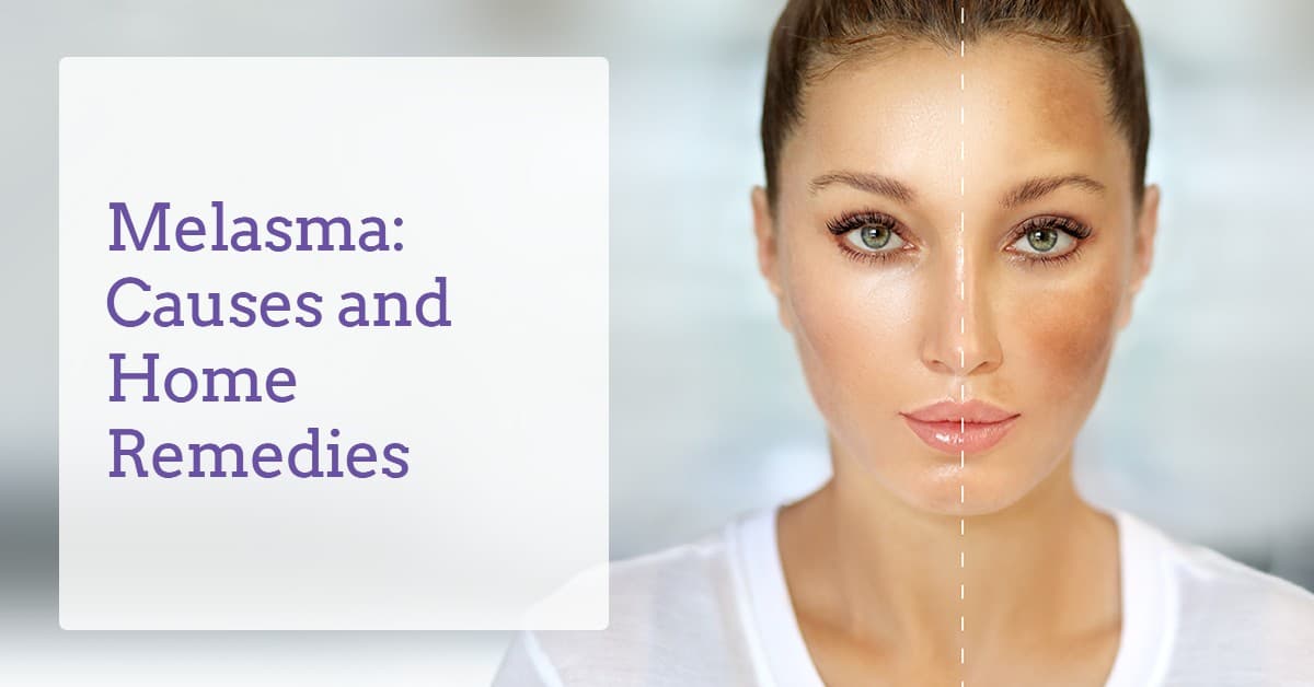 Melasma Causes Home Remedies And Melasma Treatment Derma Essentia