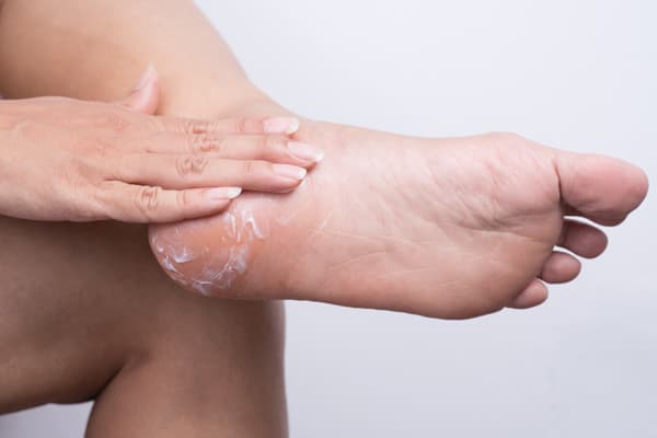 Best Cream For Cracked Heels