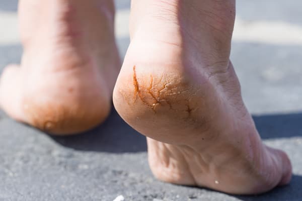 Home Remedies for Cracked Heels | Foot Specialists