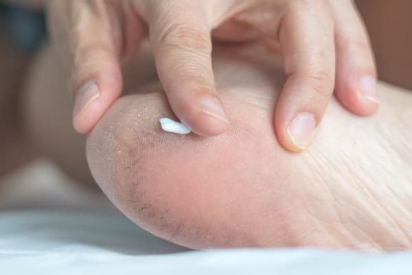 Cracked Heels: Causes, Treatment, Prevention | ClearSkin