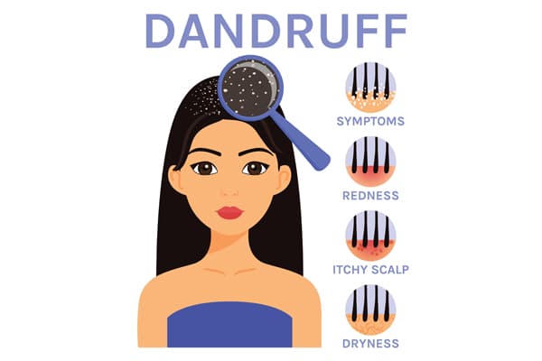 Dandruff