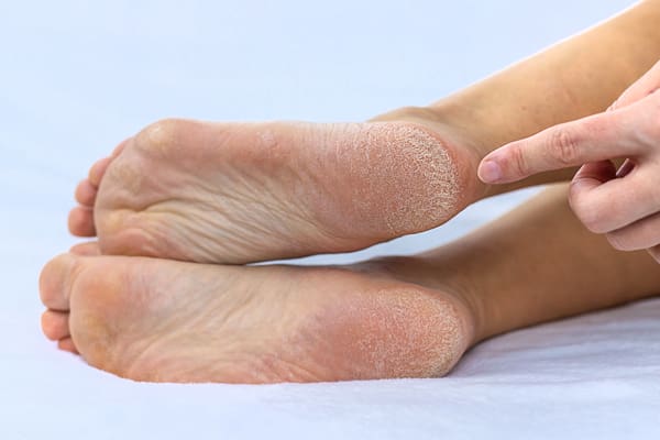 Dry and cracked feet? Causes and treatments at home - Natural Wellbeing