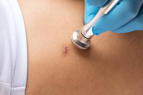 Keloid Scar Removal