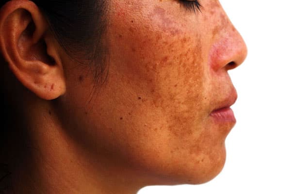 Melasma