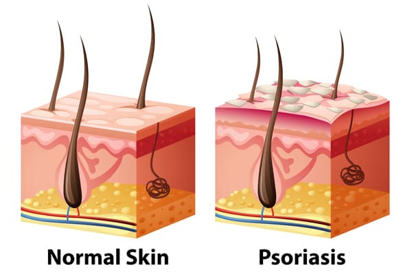 Psoriasis