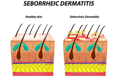 Seborrheic-Dermatitis-dermaessentia