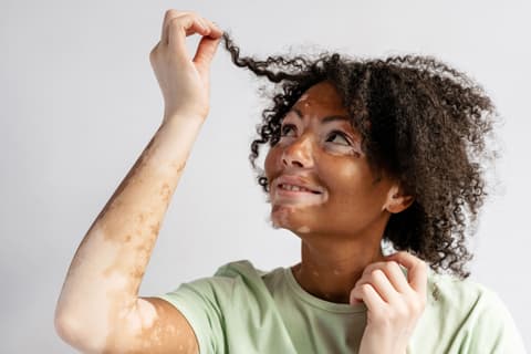 Vitiligo