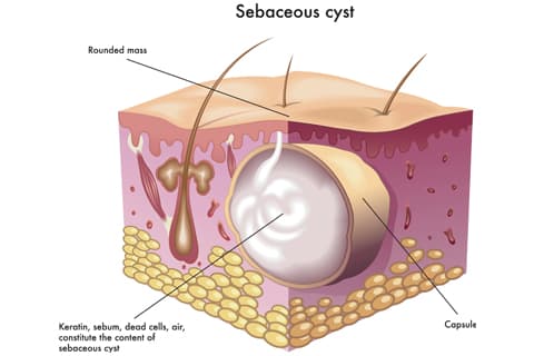 What Is A Sebaceous Cyst