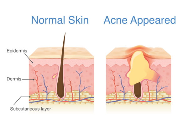 What Is Acne Breakout