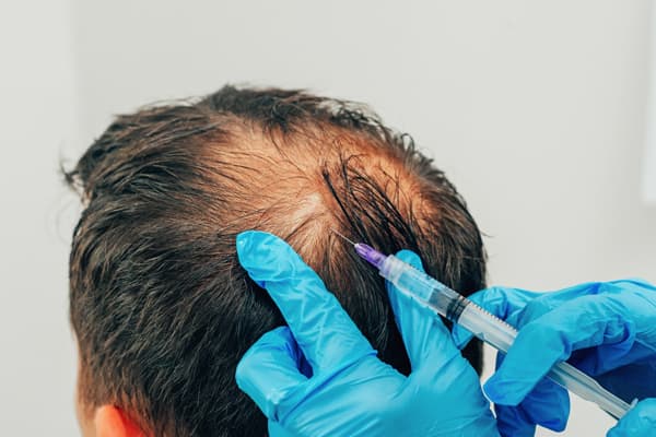 What Is The Best Treatment For Alopecia